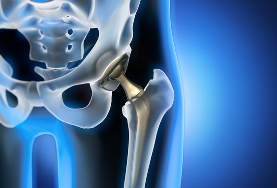 A Guide to Hip Replacement Surgery